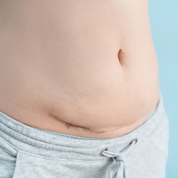 c-section scar