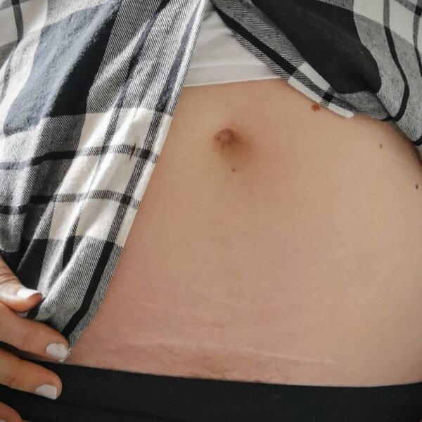 C-section scar