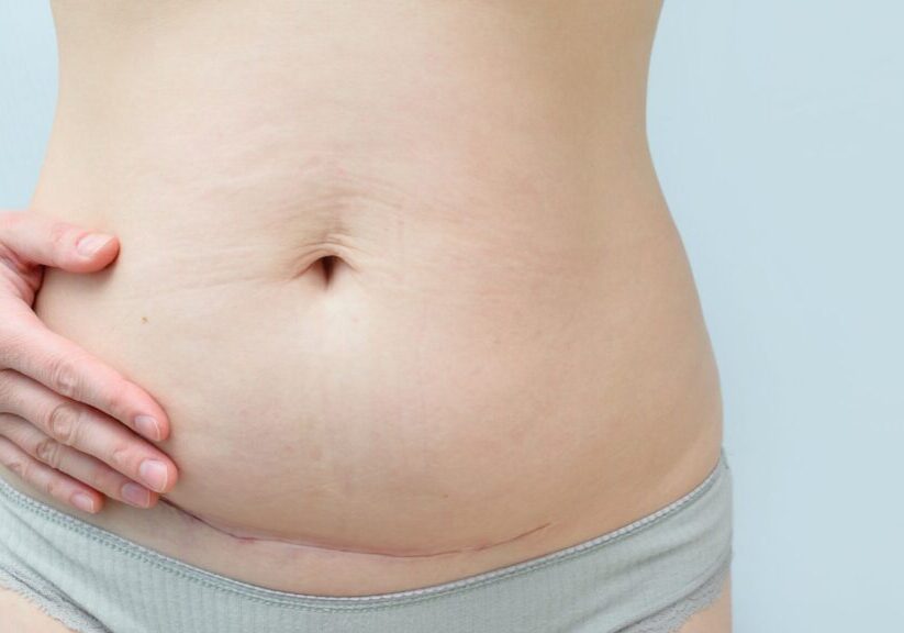 M37071 - One Core Repair - A Personal History of the C-Section featured img